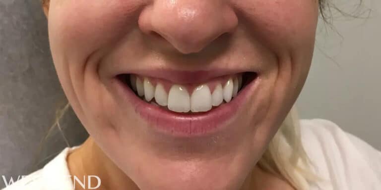 Before Image: Lip Filler - front