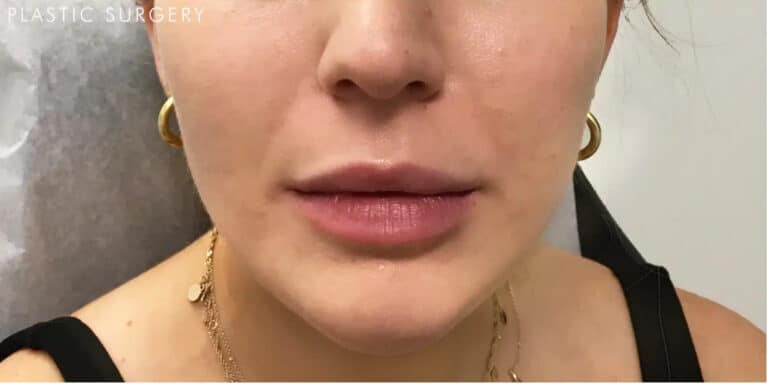 After Image: Botox in Masseter and Filler in Chin & Cheeks - front