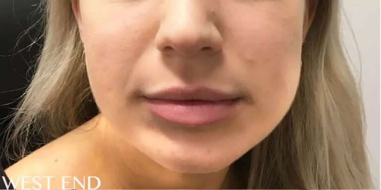 Before Image: Botox in Masseter and Filler in Chin & Cheeks - front