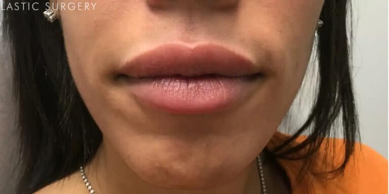 After Image: Lip Filler - front