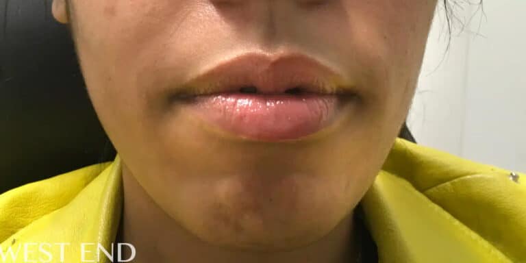 Before Image: Lip Filler - front