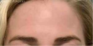 After Image: Dysport, IPL & Jessner’s Peel