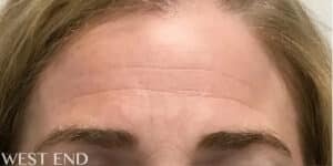 Before Image: Dysport, IPL & Jessner’s Peel