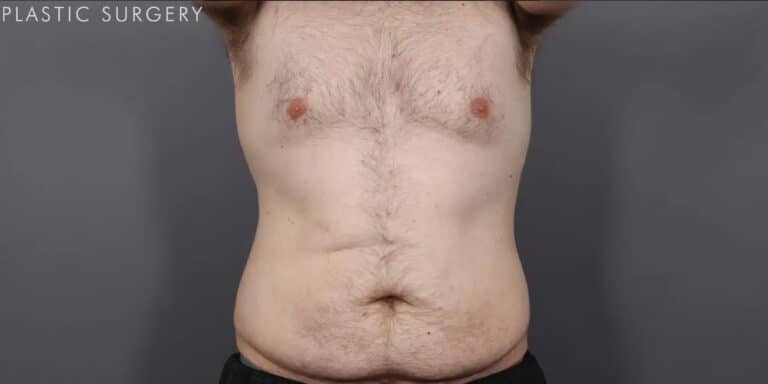 After Image: CoolSculpting - front