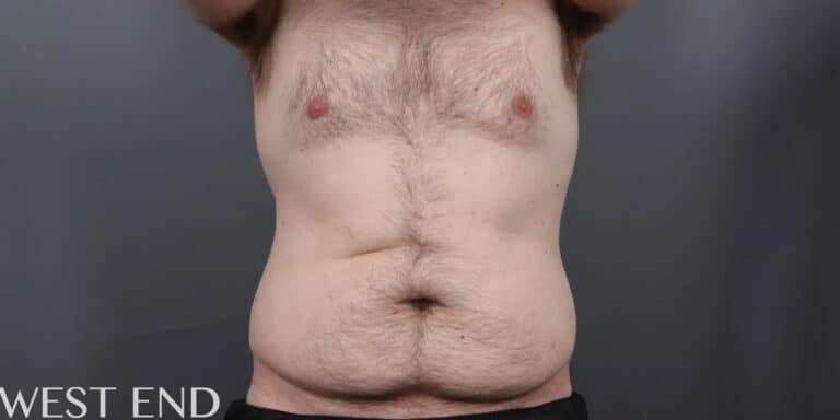 Before Image: CoolSculpting - front
