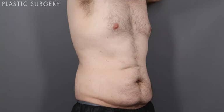 After Image: CoolSculpting - right-front-oblique