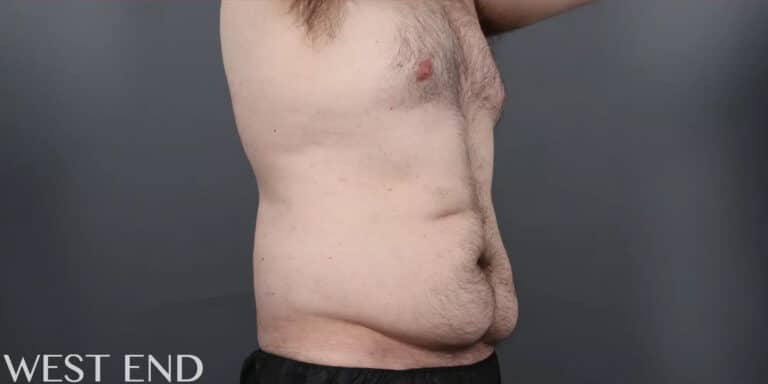 Before Image: CoolSculpting - right-front-oblique