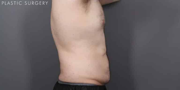 After Image: CoolSculpting - right-side