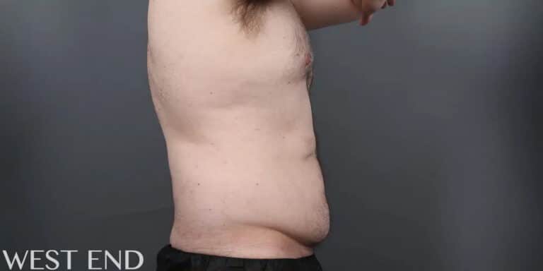 Before Image: CoolSculpting - right-side