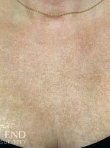 After Image: Sculptra & Microneedling