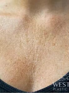 Before Image: Sculptra & Microneedling