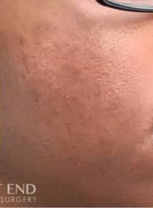 After Image: Mini Melanage and Facial + Glycolic Peel