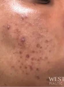 Before Image: Mini Melanage and Facial + Glycolic Peel