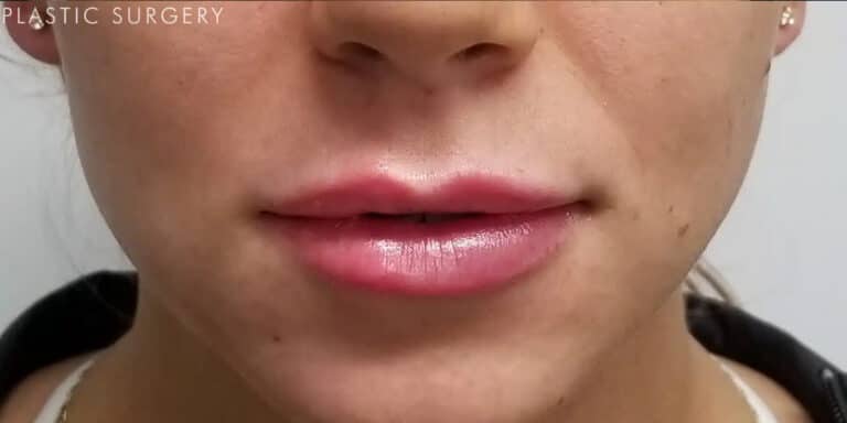 After Image: Lip Filler - front