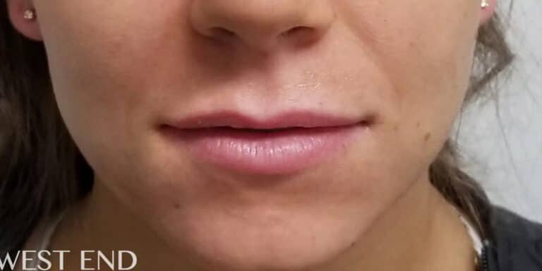 Before Image: Lip Filler - front