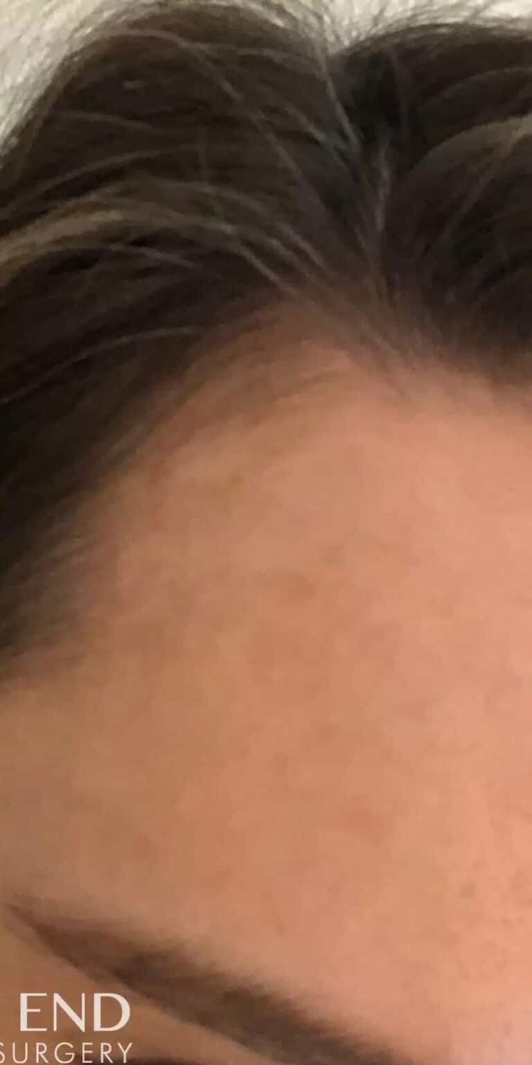 After Image: Melasma Treatment with Tetra CO2 CoolPeel and Medical Grade Skincare - front