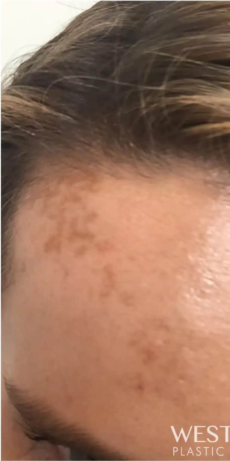 Before Image: Melasma Treatment with Tetra CO2 CoolPeel and Medical Grade Skincare - front
