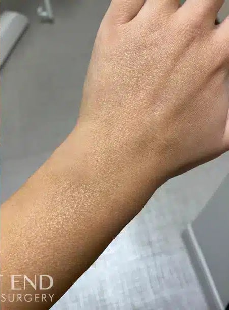 After Image: Scar Management with IPL and NewGel+ - front