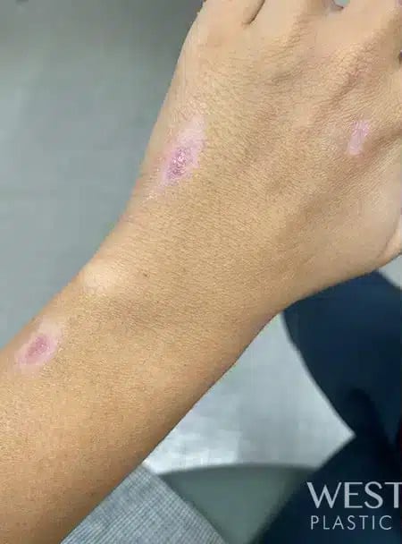 Before Image: Scar Management with IPL and NewGel+ - front