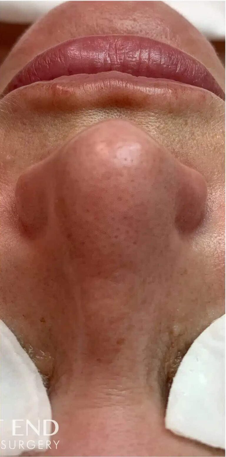 After Image: Facial with Extractions - front