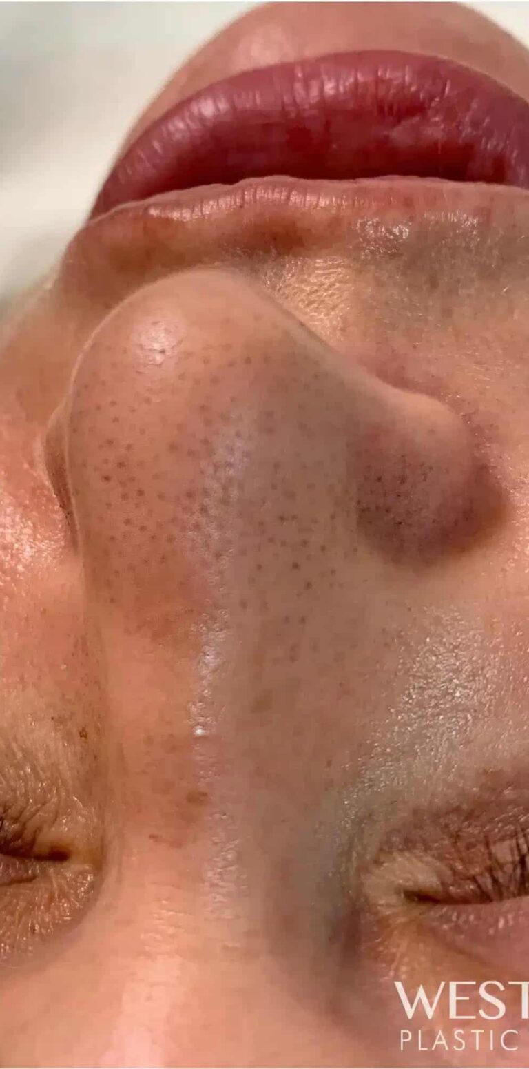 Before Image: Facial with Extractions - front
