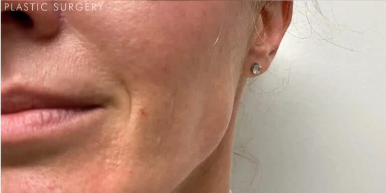 After Image: Botox in the Masseter Muscle (Jaw Clenching) - left-front-oblique