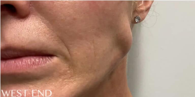 Before Image: Botox in the Masseter Muscle (Jaw Clenching) - left-front-oblique
