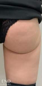 After Image: Kybella