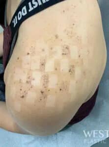 Before Image: LED Light Therapy & Growth Factors