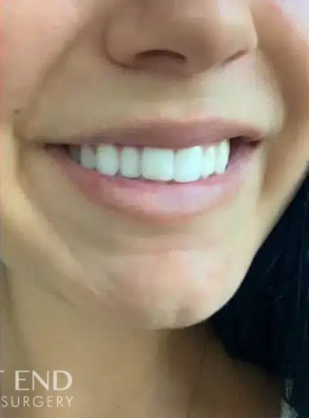 After Image: Lip Filler - right-front-oblique