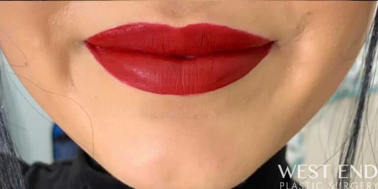 After Image: Lip Filler - front