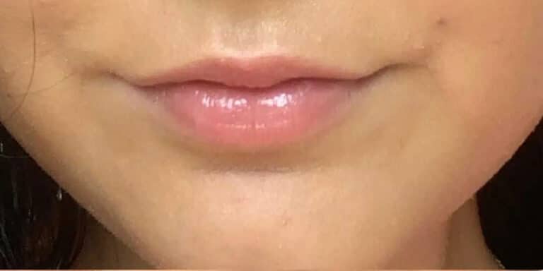 Before Image: Lip Filler - front