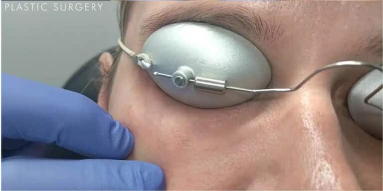 After Image: Under Eye Vein Removal with the Cutera YAG Laser - front