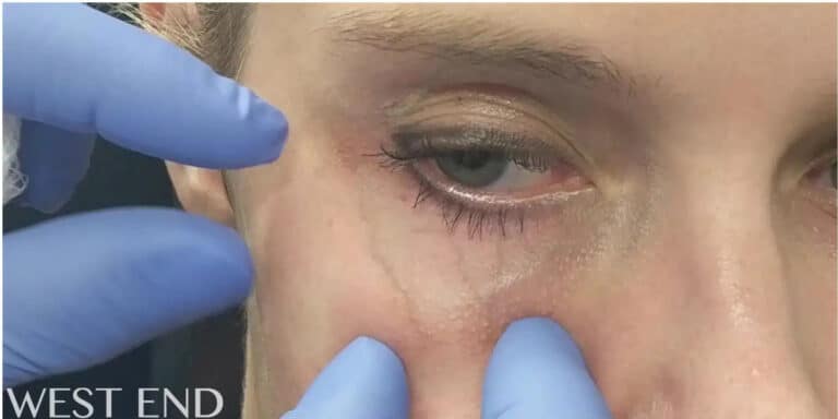 Before Image: Under Eye Vein Removal with the Cutera YAG Laser - front