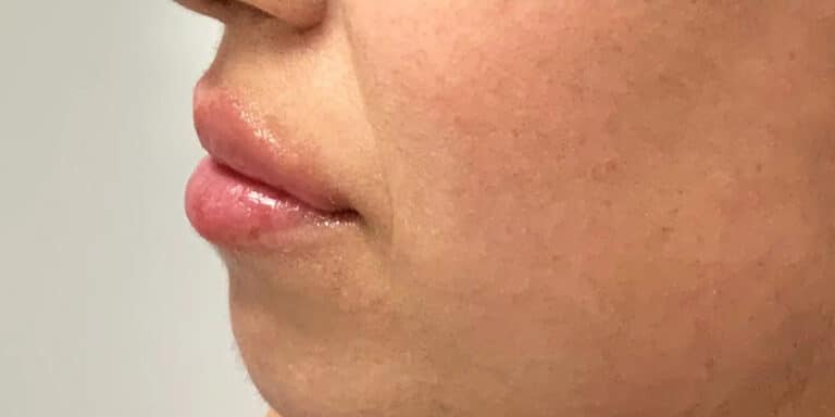 After Image: Lip Filler - left-side