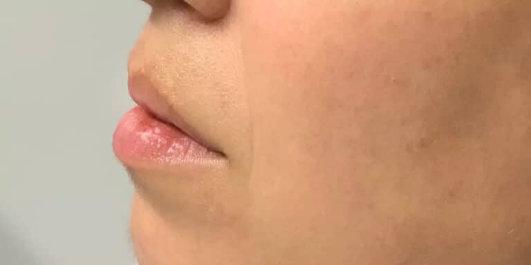 Before Image: Lip Filler - left-side