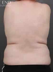 After Image: CoolSculpting