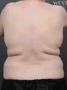 Before Image: CoolSculpting