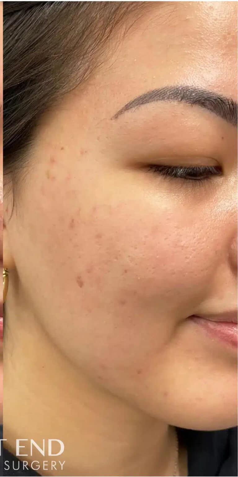 After Image: Microneedling with PRP for Acne Scars - right-front-oblique