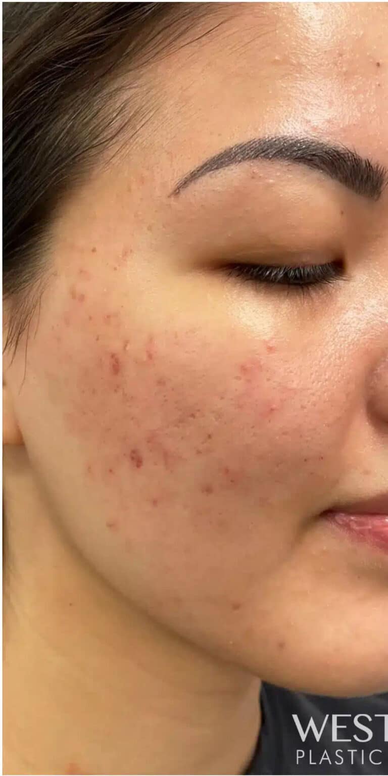 Before Image: Microneedling with PRP for Acne Scars - right-front-oblique