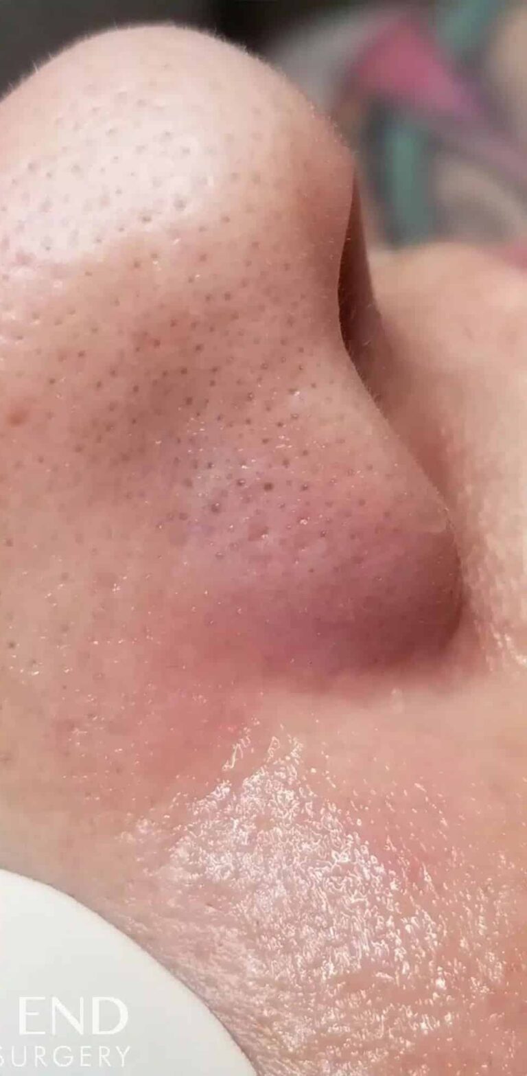 After Image: IPL (Vascular M22 Laser) - right-side