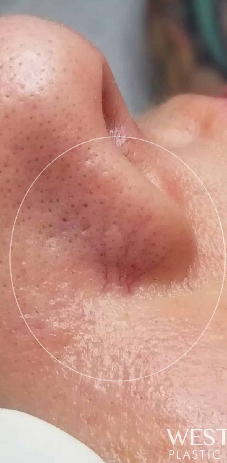 Before Image: IPL (Vascular M22 Laser) - right-side