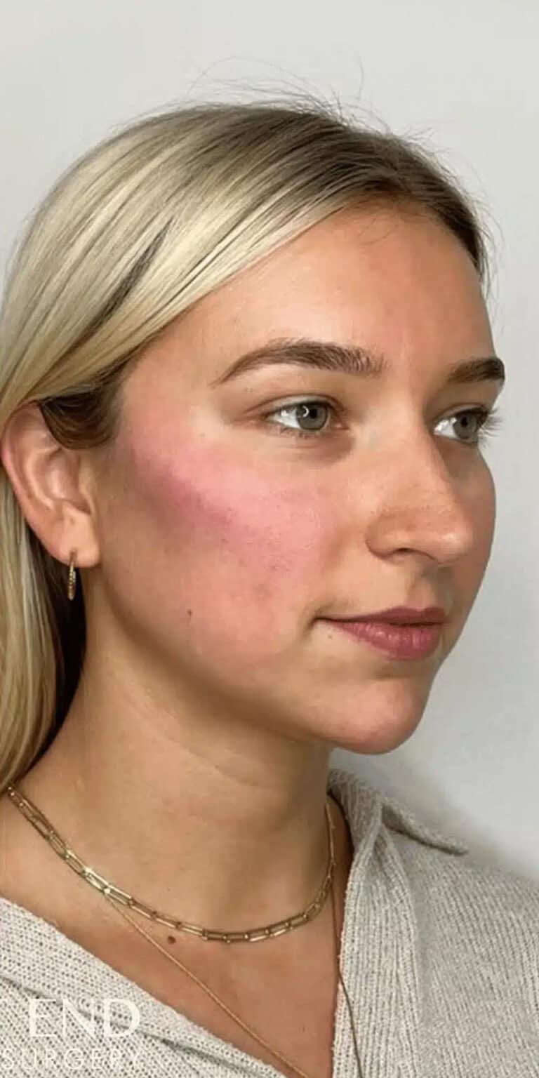 After Image: Cheek, Jawline, & Chin Filler - right-front-oblique