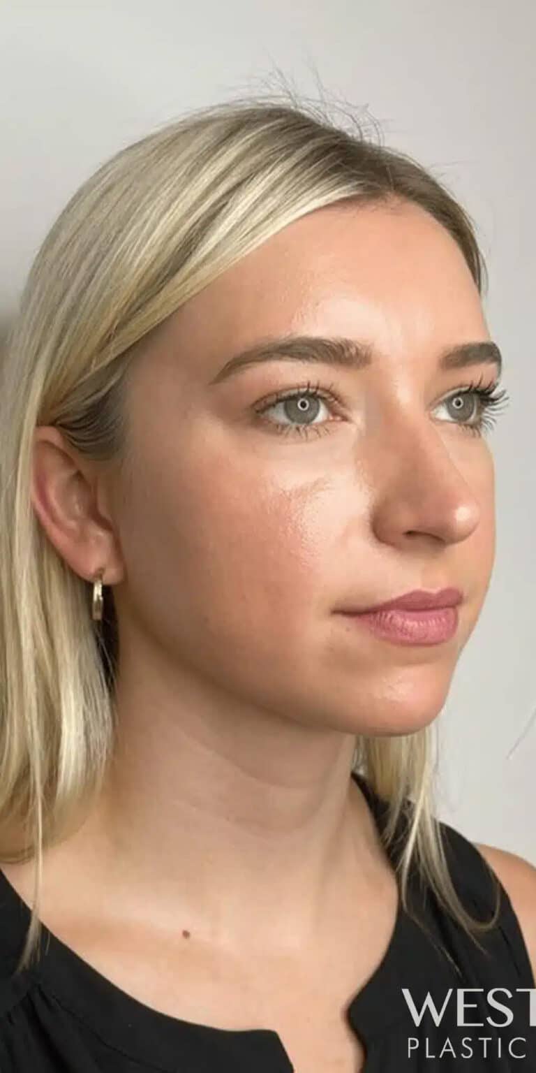 Before Image: Cheek, Jawline, & Chin Filler - right-front-oblique