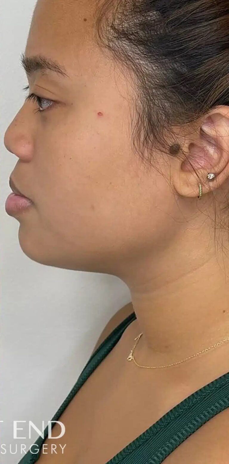 After Image: Kybella - left-side