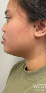 Before Image: Kybella