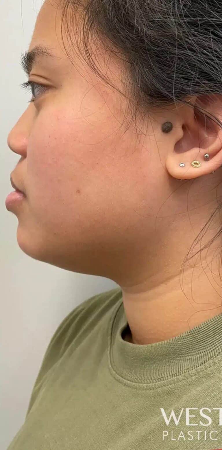 Before Image: Kybella - left-side