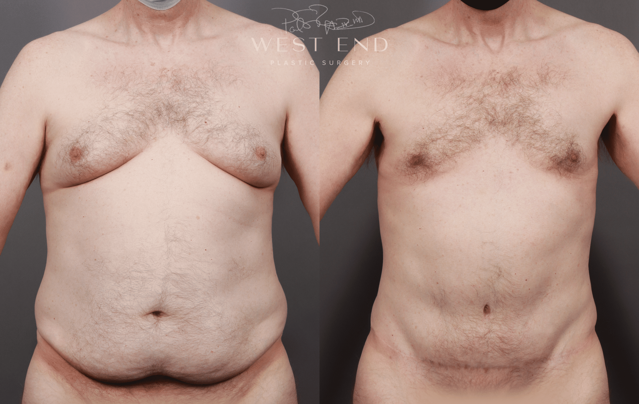 Abdominoplasty Washington DC