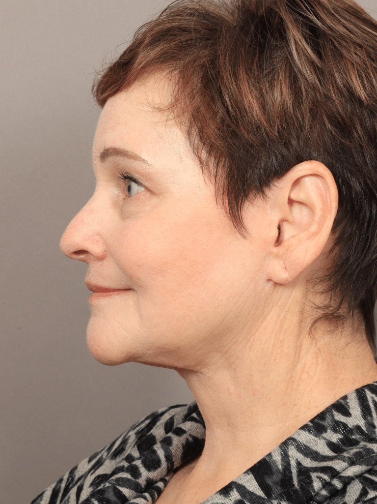 After Image: Deep Plane Facelift & Neck Lift, Brow Lift, Eyelid Lift, Lip Lift, Fat Grafting, and CO2 Resurfacing (1 Year Post-Op) - left-side