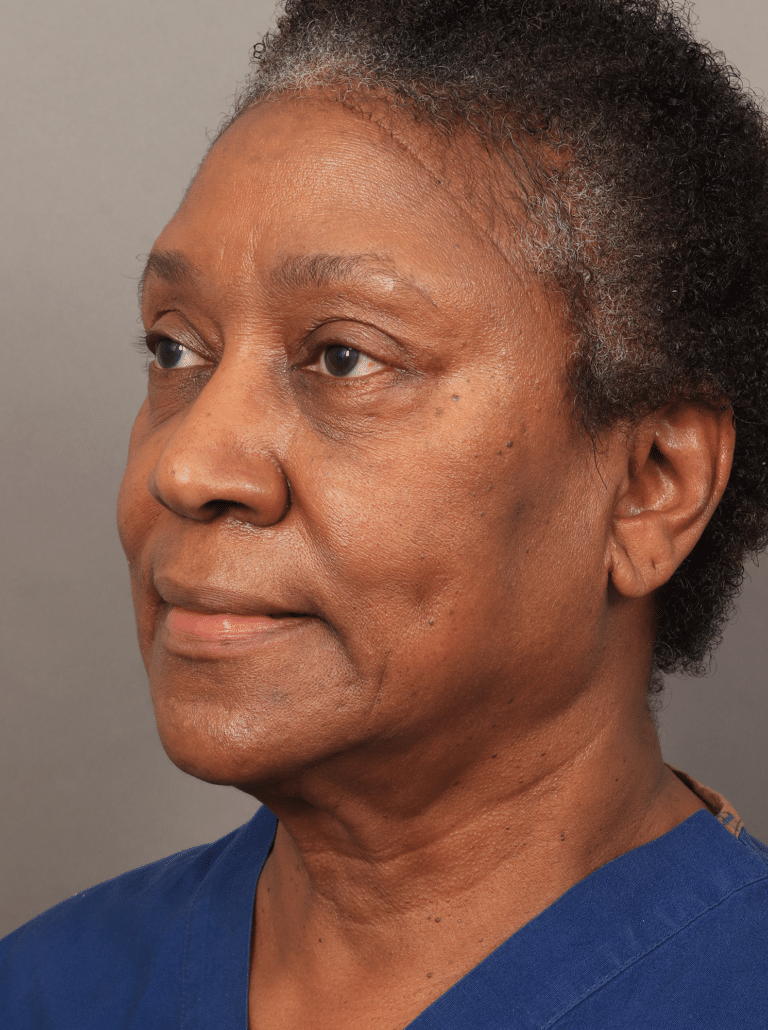 Before Image: Lower Face & Neck Lift, Upper Eyelid Lift, Brow Lift, and Fat Grafting (2 Weeks Post-op) - left-front-oblique